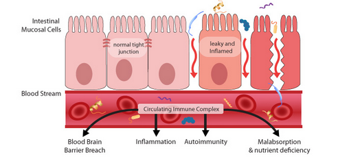 leaky-gut